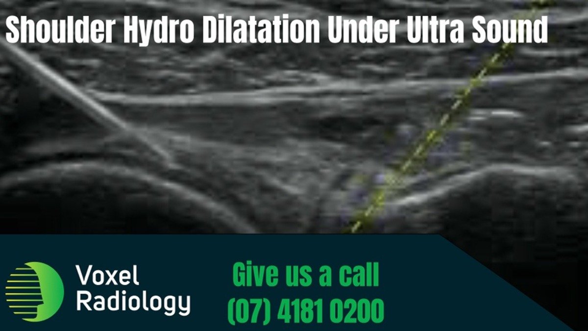 Hyaluronic acid injections Bundaberg