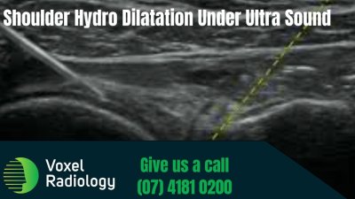 Hyaluronic acid injections Bundaberg